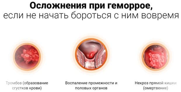 Proktonol геморрой препараты, емделусіз асқынулар